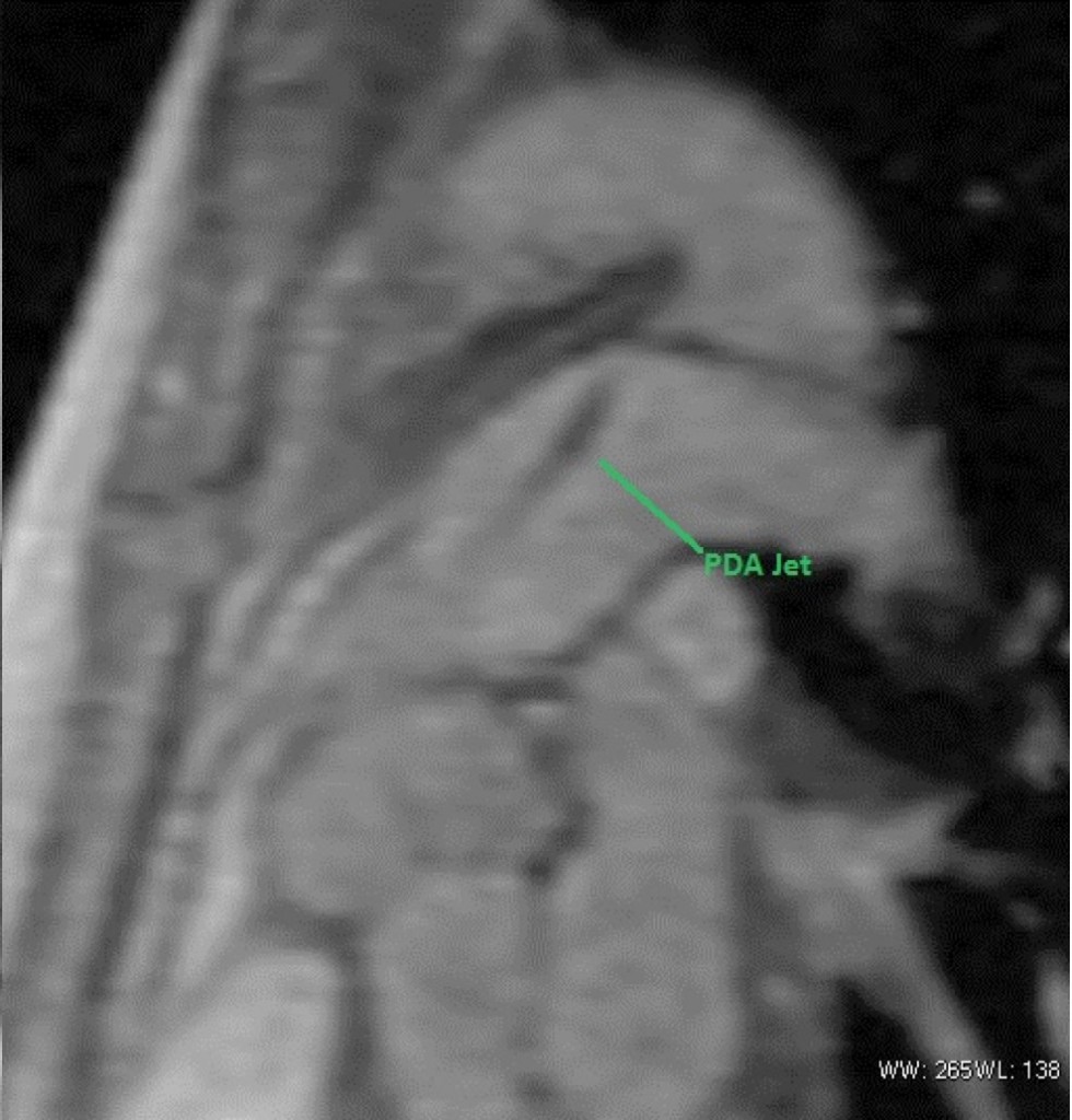 PDA2 Cardiac MRI