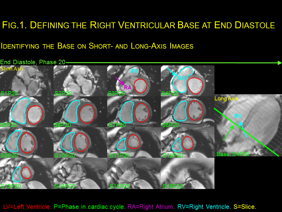 End-Diastolic Volume Index - Cardiac MRI