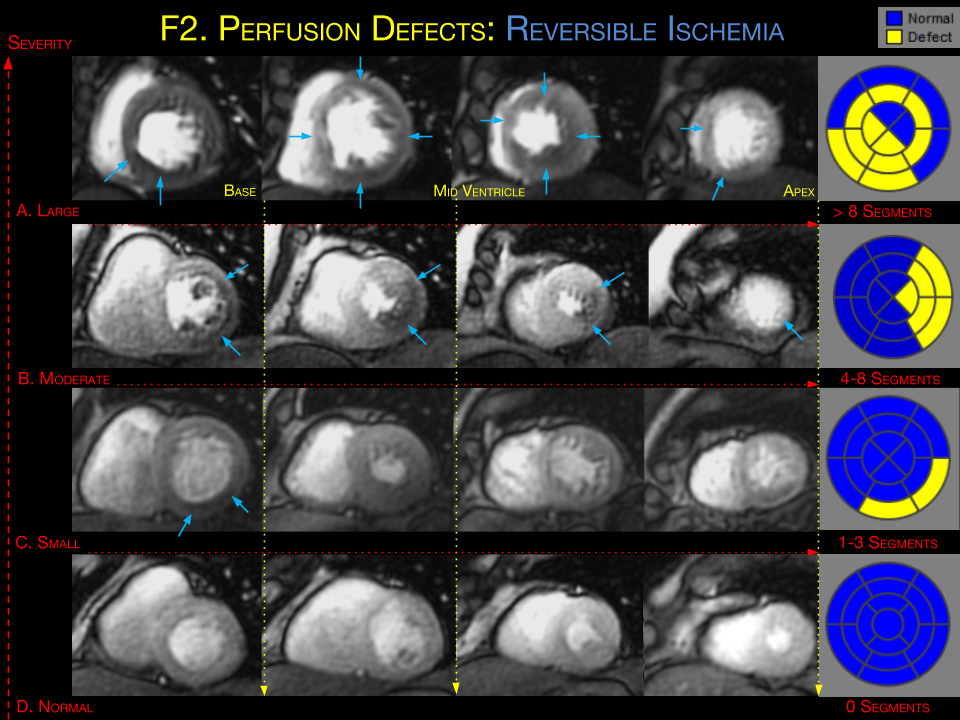 myocardial-perfusion-cardiac-mri